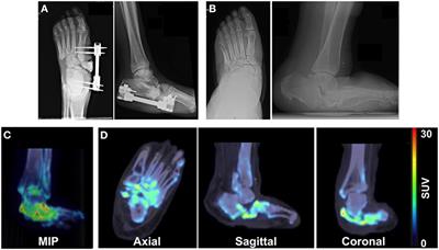 Novel Application of 18F-NaF PET/CT Imaging for Evaluation of Active Bone Remodeling in Diabetic Patients With Charcot Neuropathy: A Proof-of-Concept Report